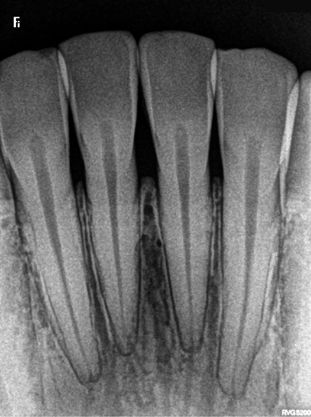 RVG 5200 Xray Image