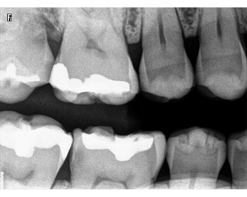 Intraoral Xray Image