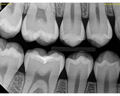 Intraoral Xray Image