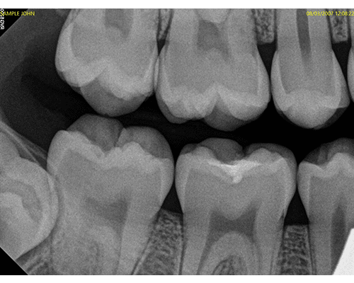 Intraoral Xray Image