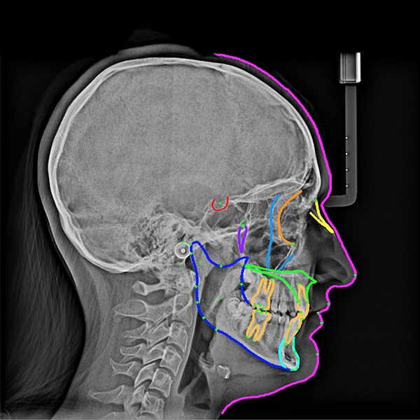 CS8100 X-Ray Image