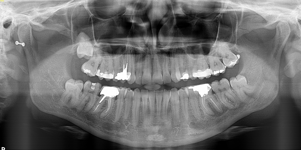 Panoramic X-Rays | Imaging Solutions